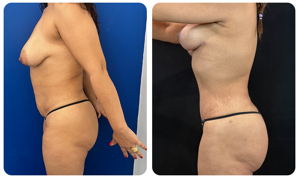 Abdominoplastía