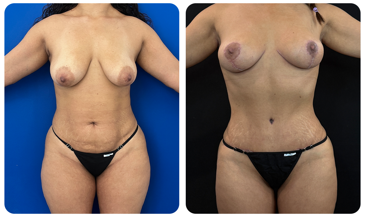 Abdominoplastía