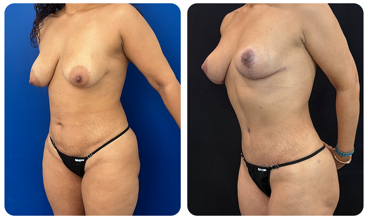 Abdominoplastía