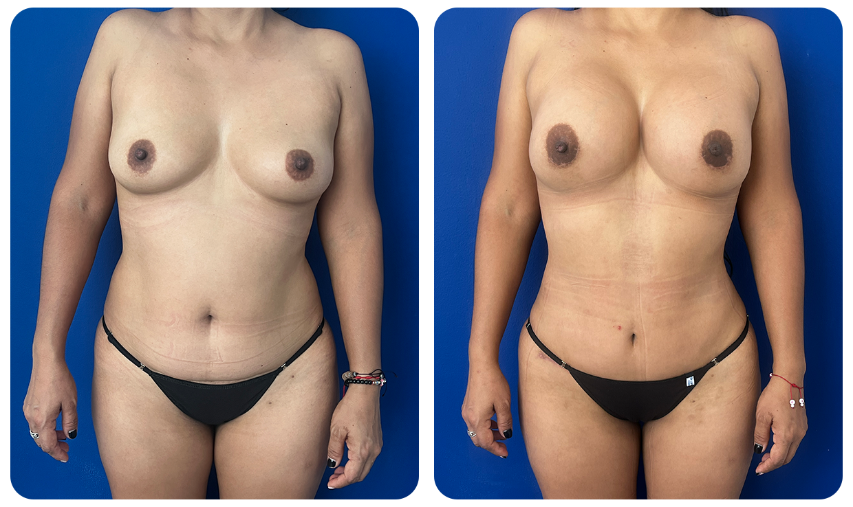 Abdominoplastía