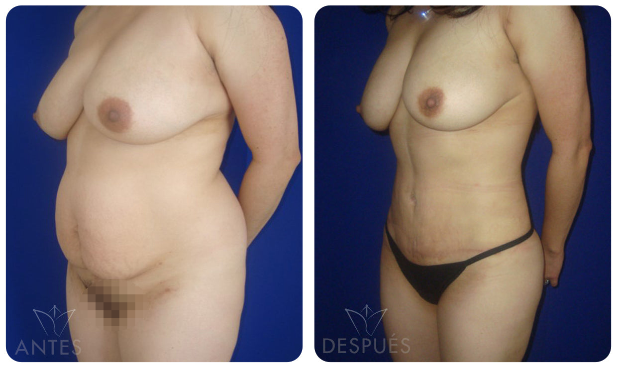 Quiero cotizar una Abdominoplastía