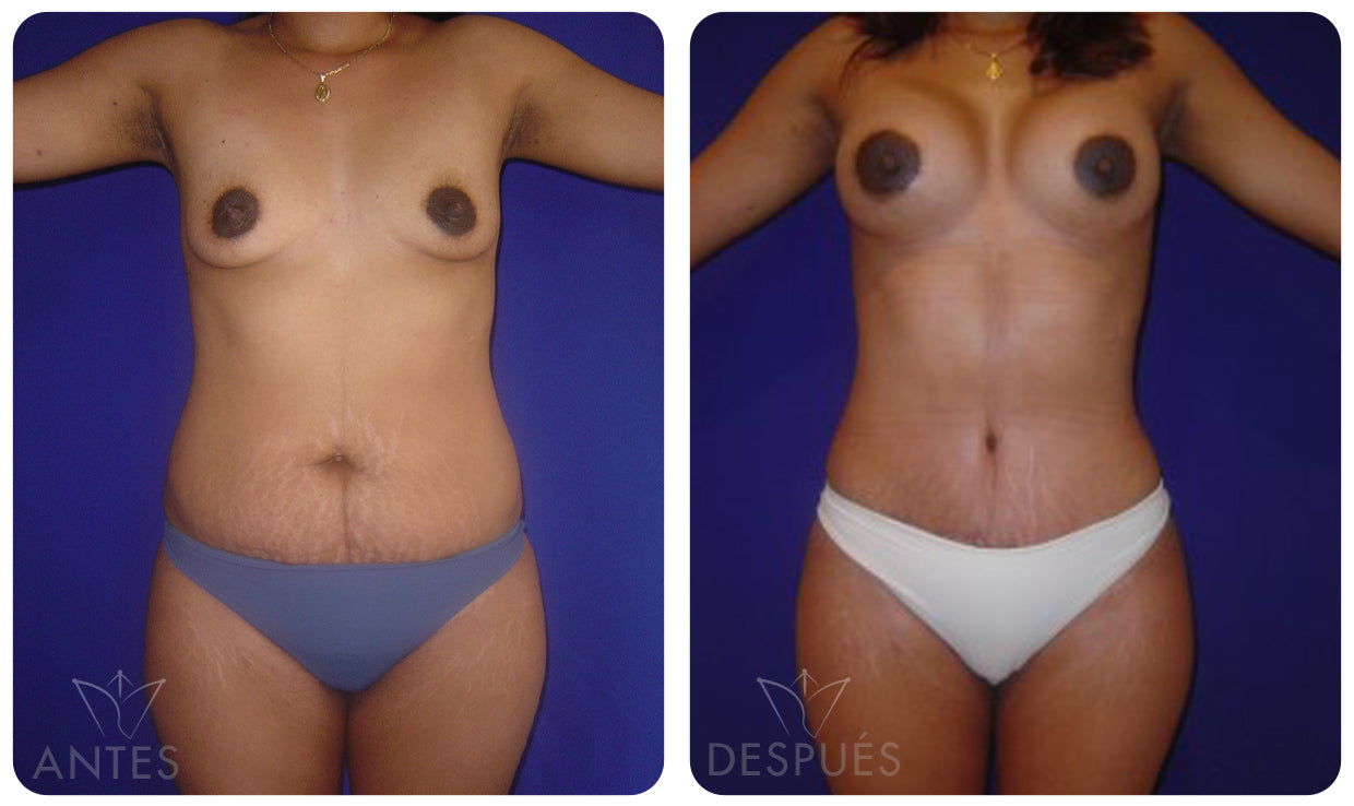 Quiero cotizar una Abdominoplastía