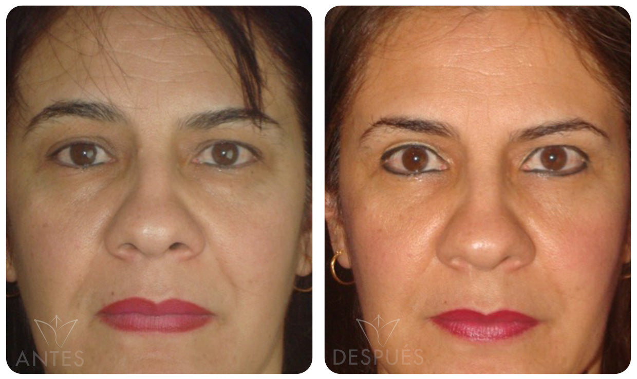 Quiero cotizar el Acido Hialuronico