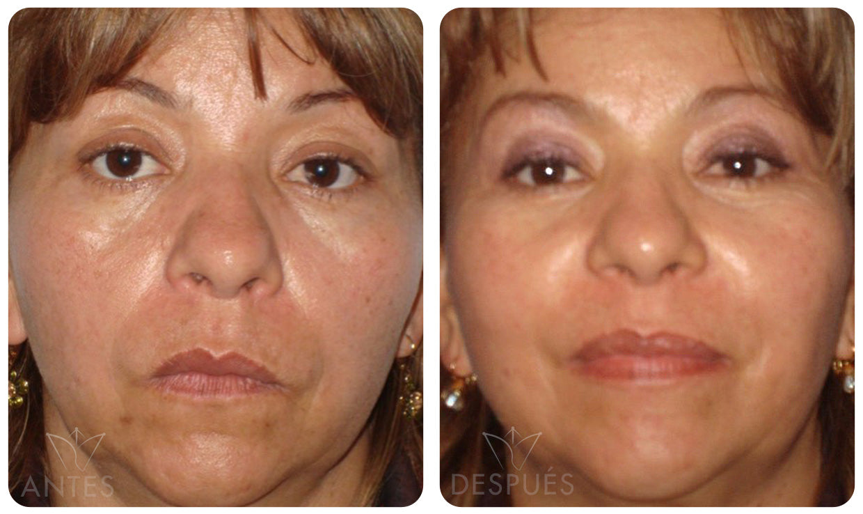 Quiero cotizar el Acido Hialuronico