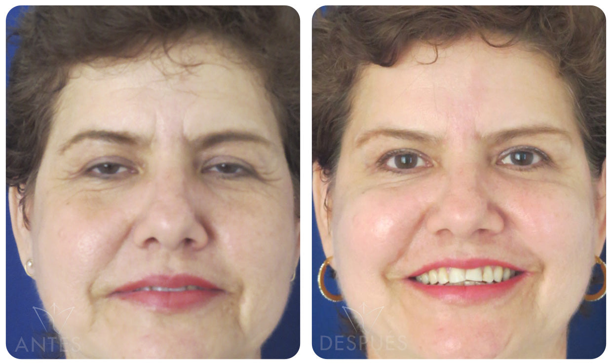 Quiero cotizar el Acido Hialuronico