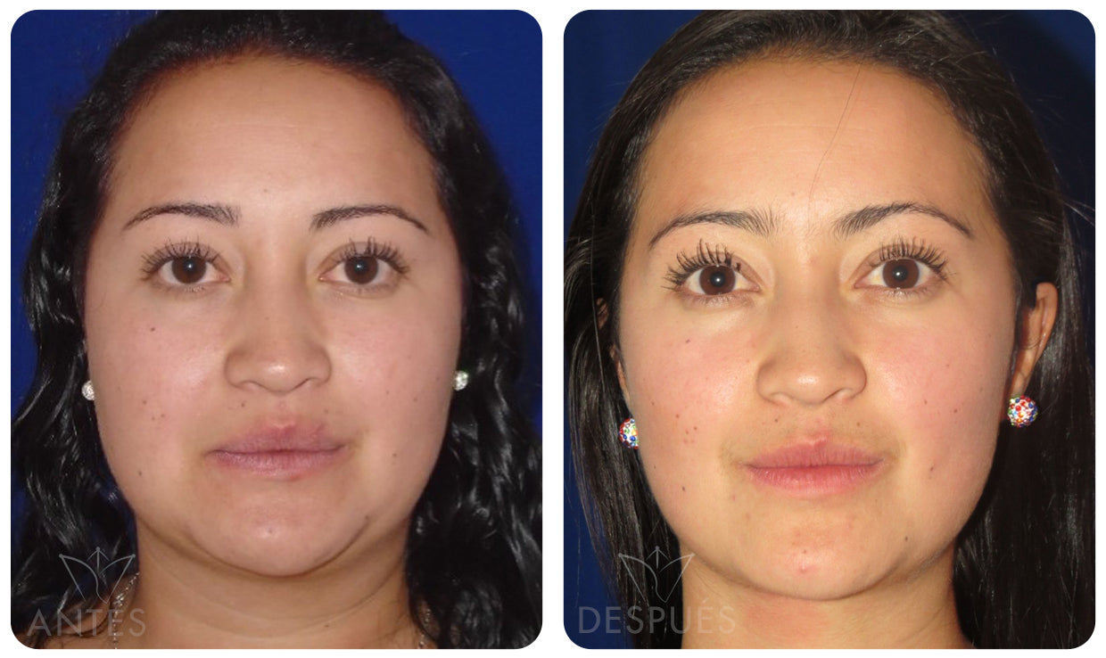 Quiero cotizar una Bichectomía