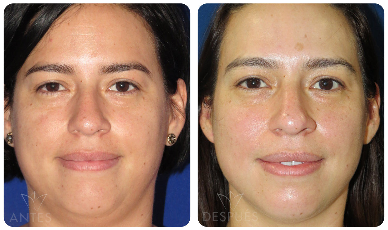 Quiero cotizar una Bichectomía