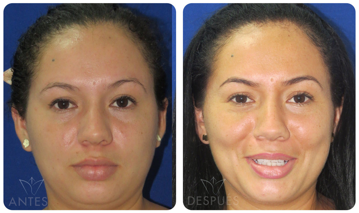 Quiero cotizar una Bichectomía