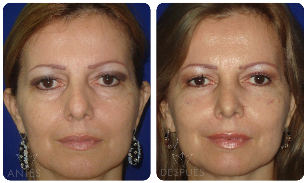 Quiero cotizar una Blefaroplastía