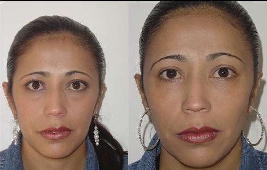 Quiero cotizar una Blefaroplastía