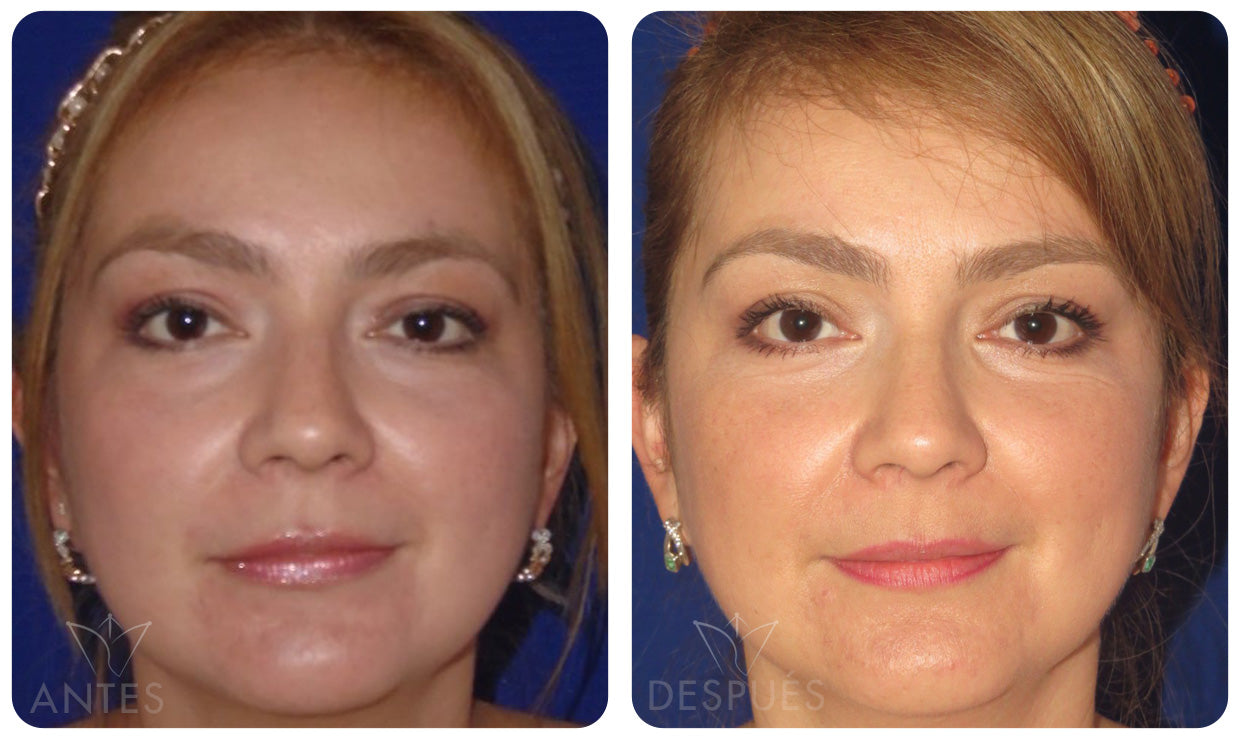 Quiero cotizar una Blefaroplastía