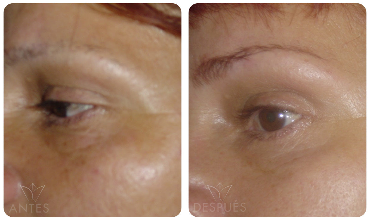 Quiero cotizar el Botox