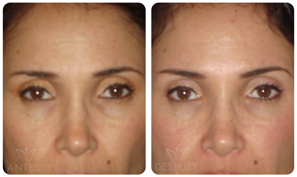 Quiero cotizar el Botox