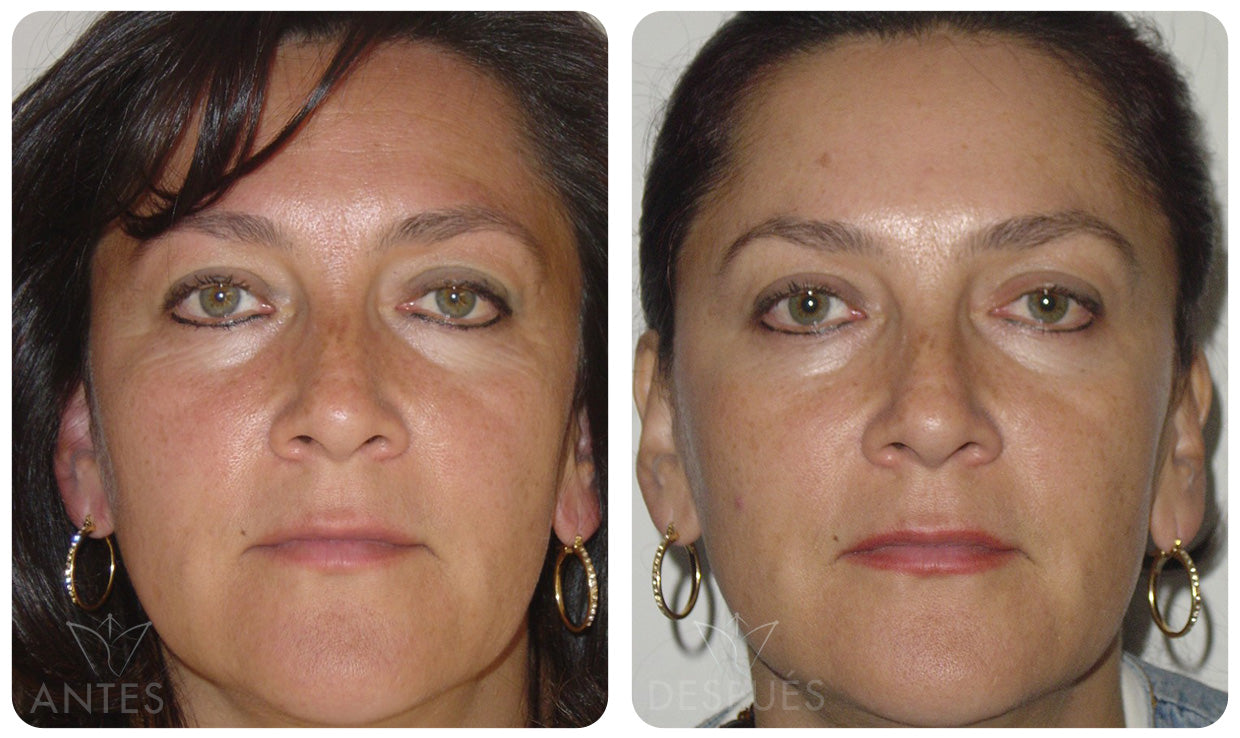 Quiero cotizar el Botox