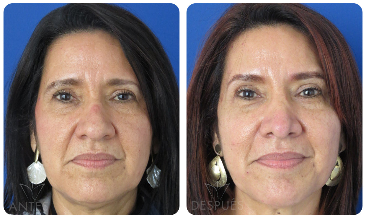 Quiero cotizar una Frontoplastía