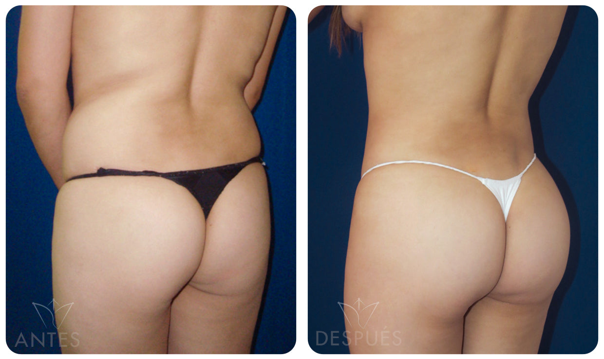 Quiero cotizar una Gluteoplastía
