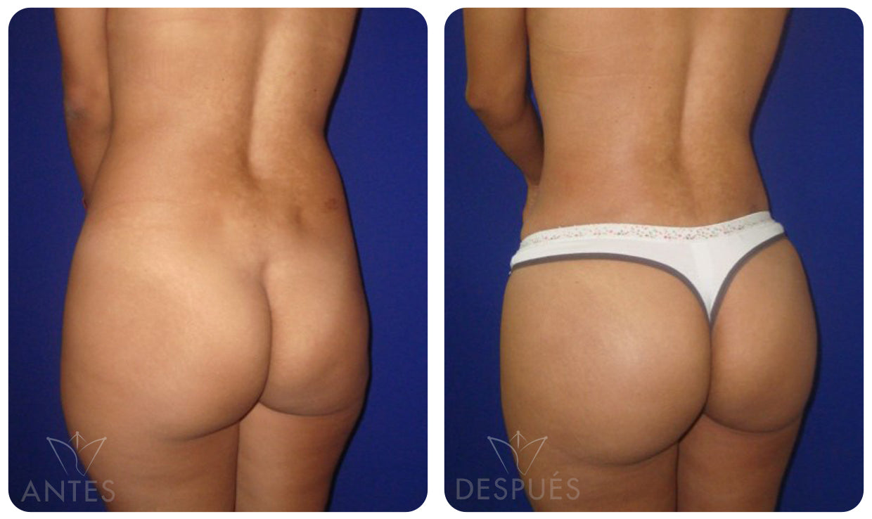 Quiero cotizar una Gluteoplastía