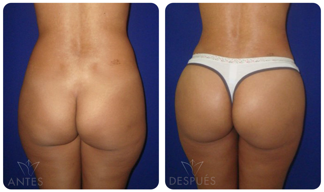 Quiero cotizar una Gluteoplastía
