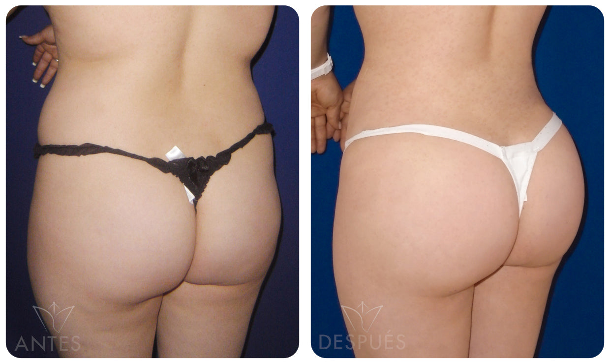 Quiero cotizar una Gluteoplastía