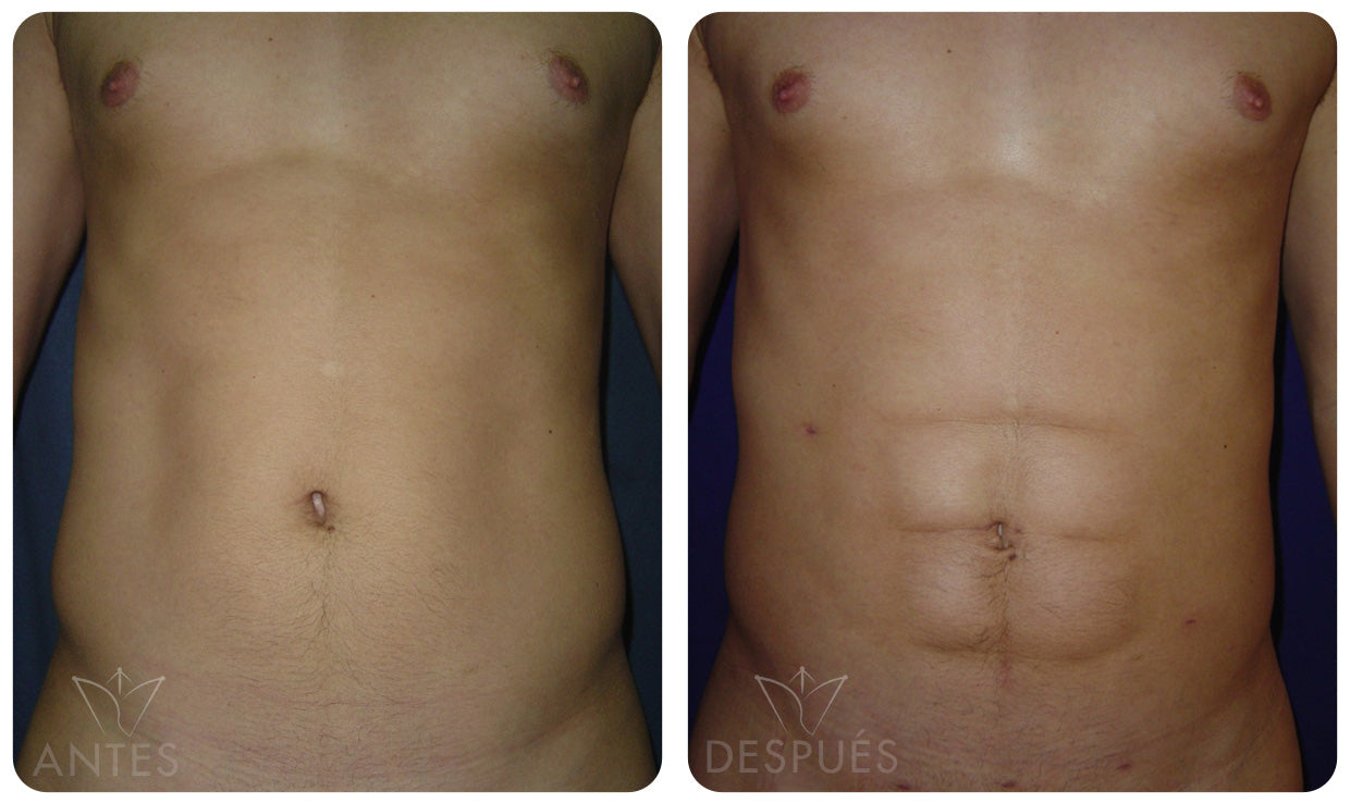 Quiero cotizar una Lipomarcación