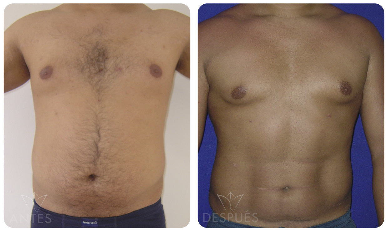 Quiero cotizar una Lipomarcación