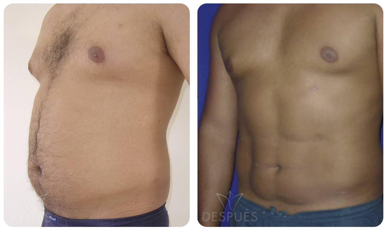 Quiero cotizar una Lipomarcación