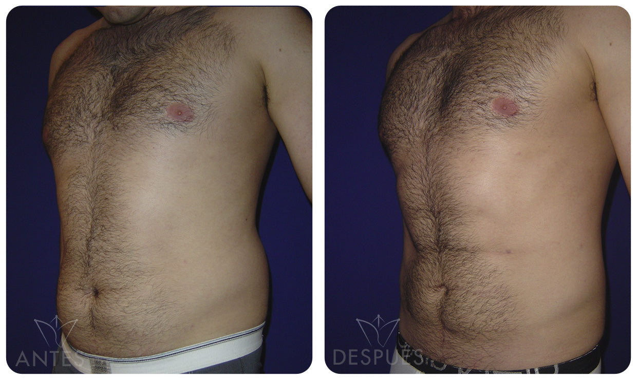 Quiero cotizar una Lipomarcación