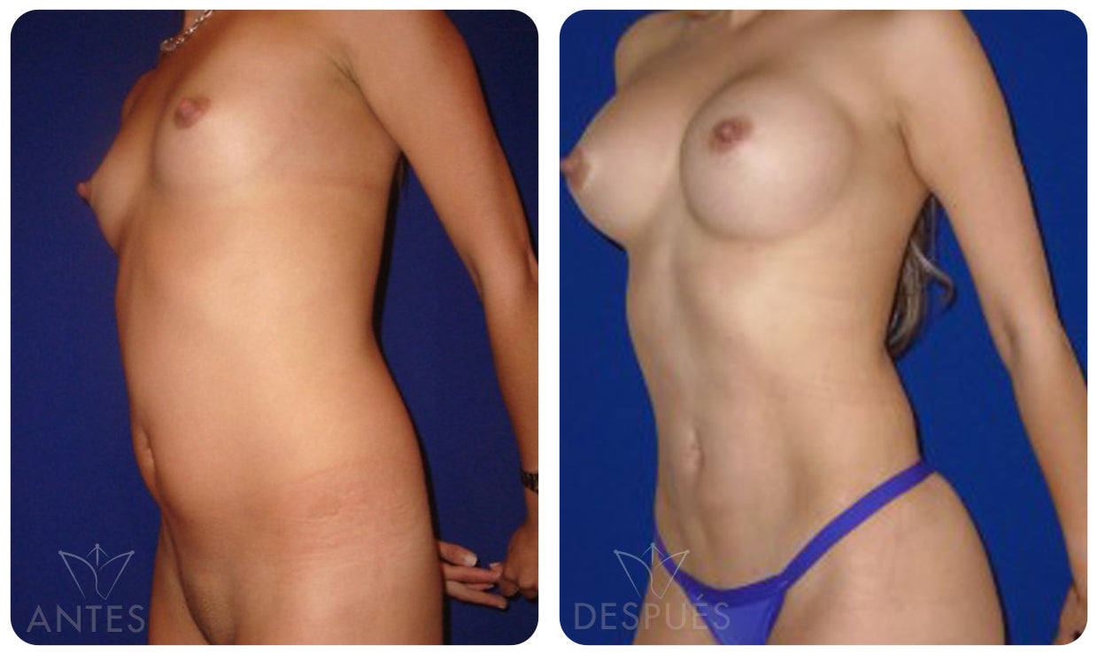 Quiero cotizar una Lipomarcación