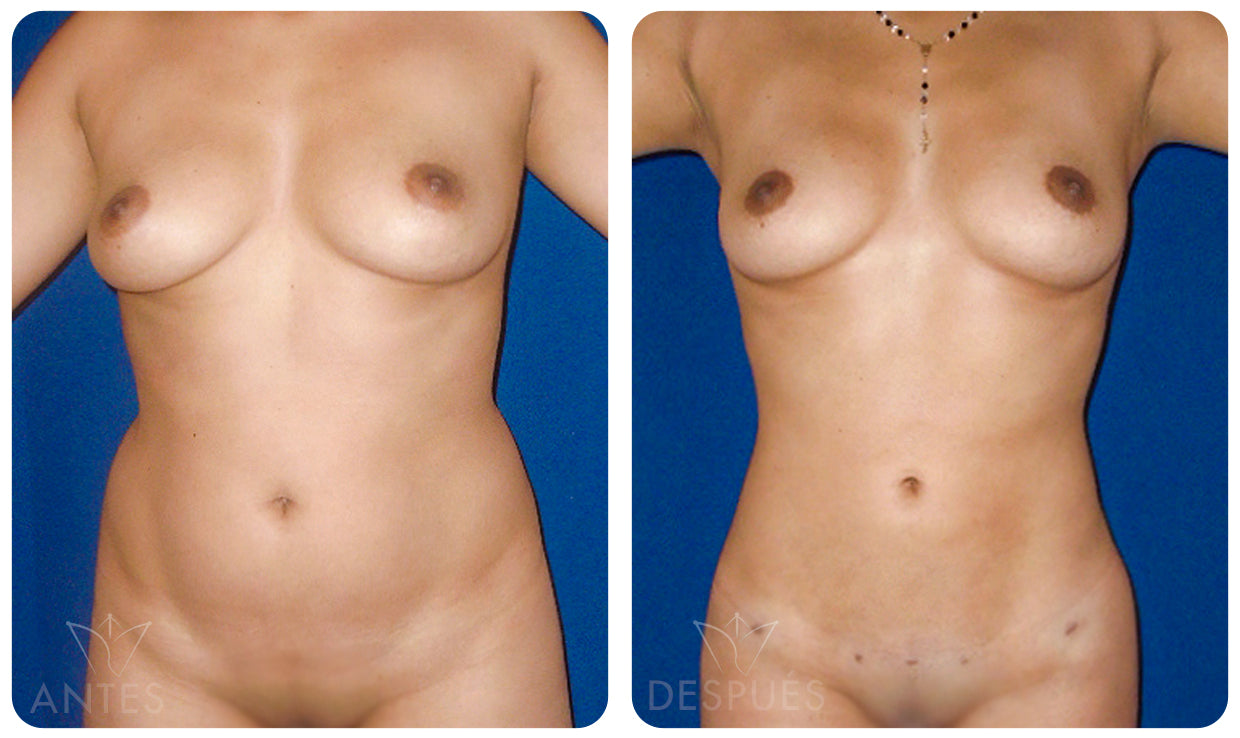 Quiero cotizar una Lipomarcación