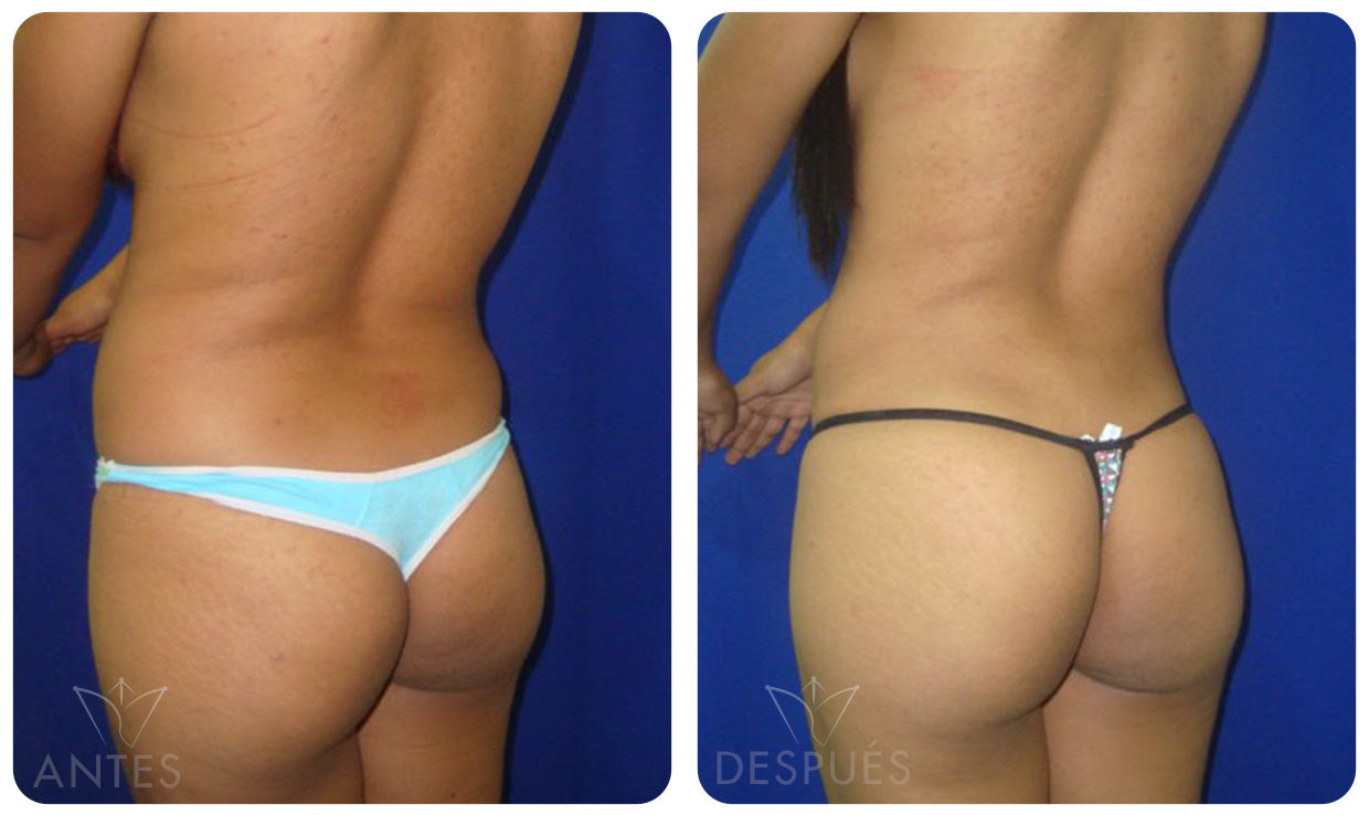 Quiero cotizar el Láser Lipólisis