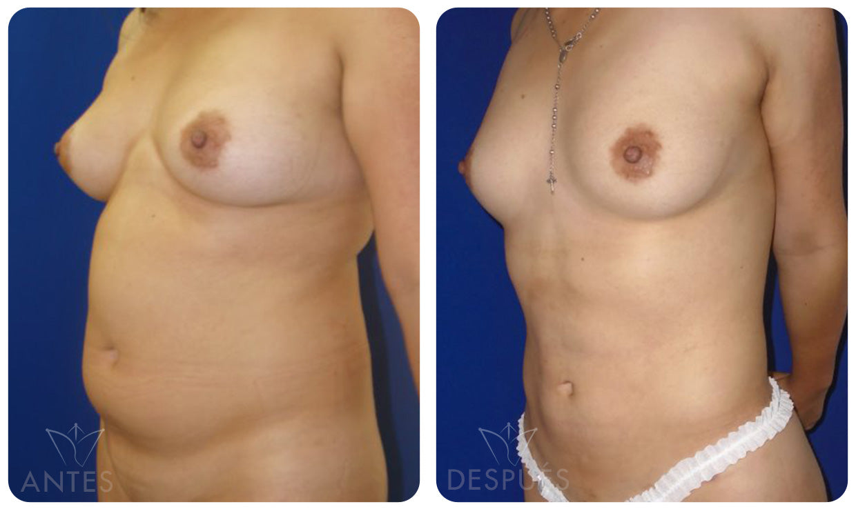 Quiero cotizar el Láser Lipólisis