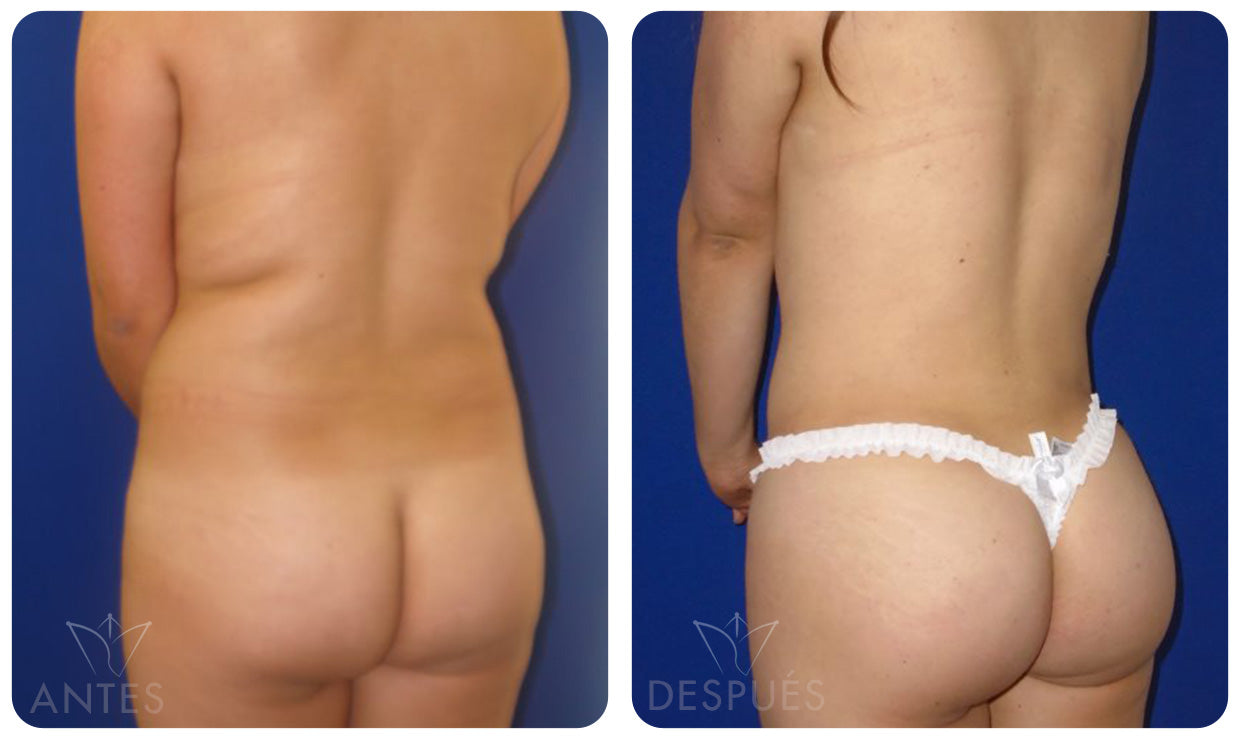 Quiero cotizar el Láser Lipólisis