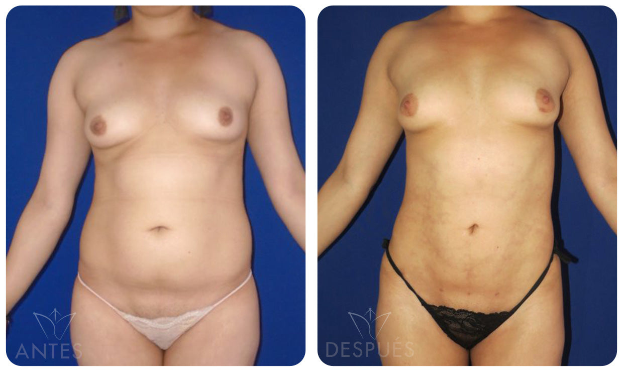 Quiero cotizar el Láser Lipólisis