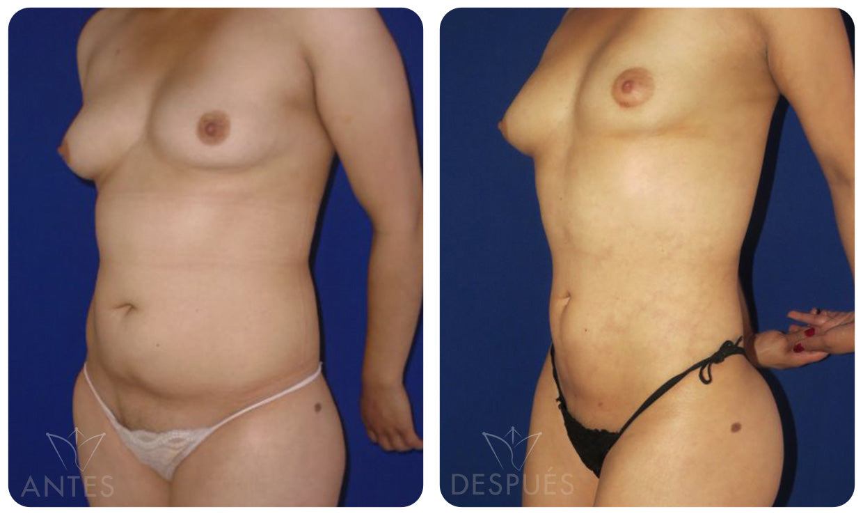 Quiero cotizar el Láser Lipólisis