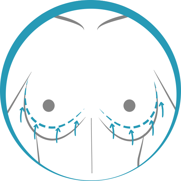 Quiero cotizar una Mamopexía