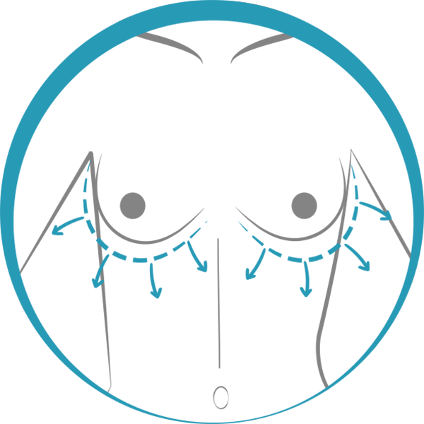 Quiero cotizar una Mamoplastía