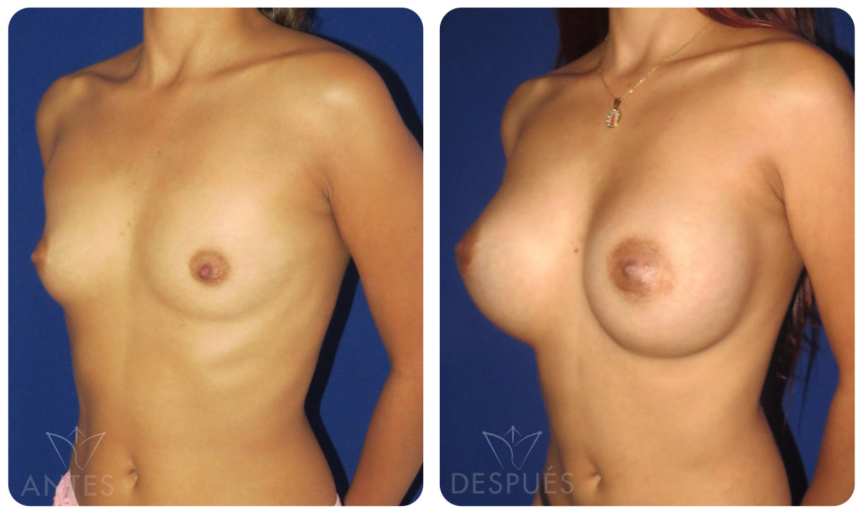 Quiero cotizar una Mamoplastía