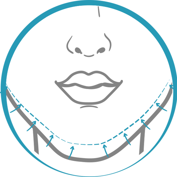 Quiero cotizar una Mentoplastía