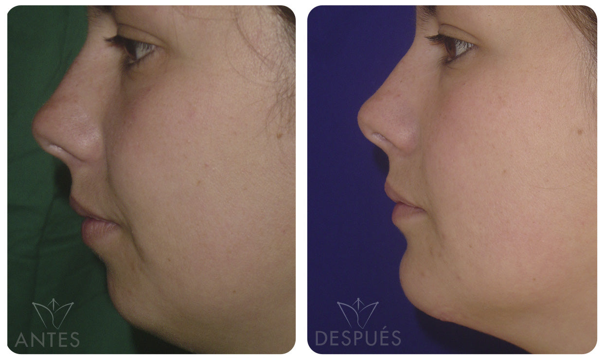 Quiero cotizar una Mentoplastía