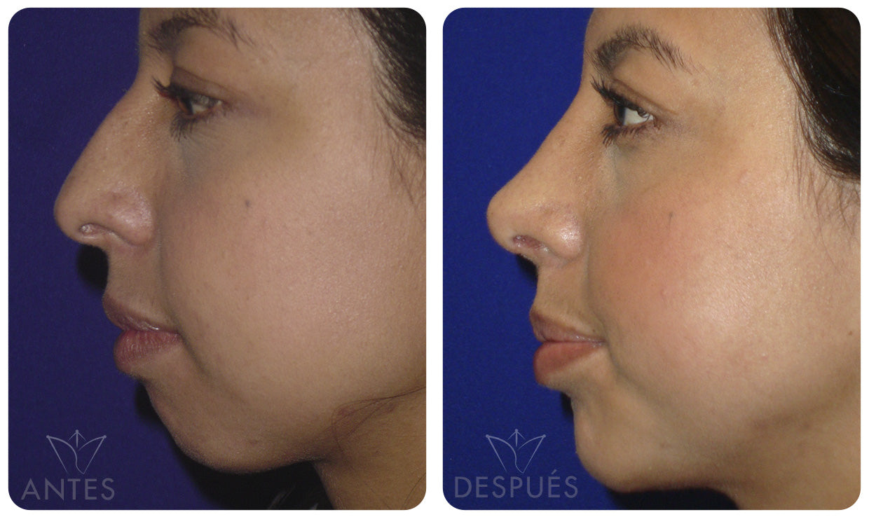 Quiero cotizar una Mentoplastía