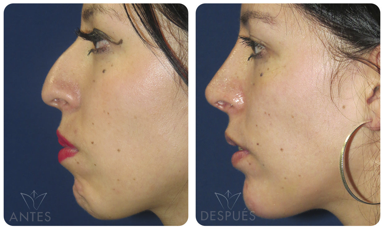 Quiero cotizar una Mentoplastía