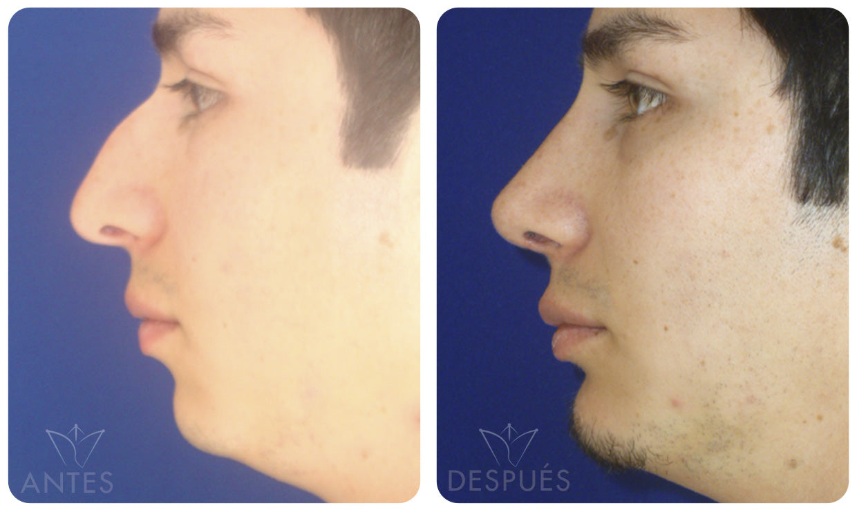 Quiero cotizar una Mentoplastía