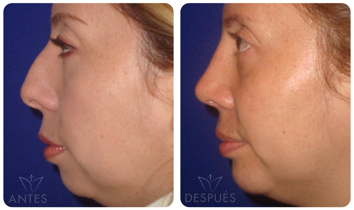 Quiero cotizar una Mentoplastía