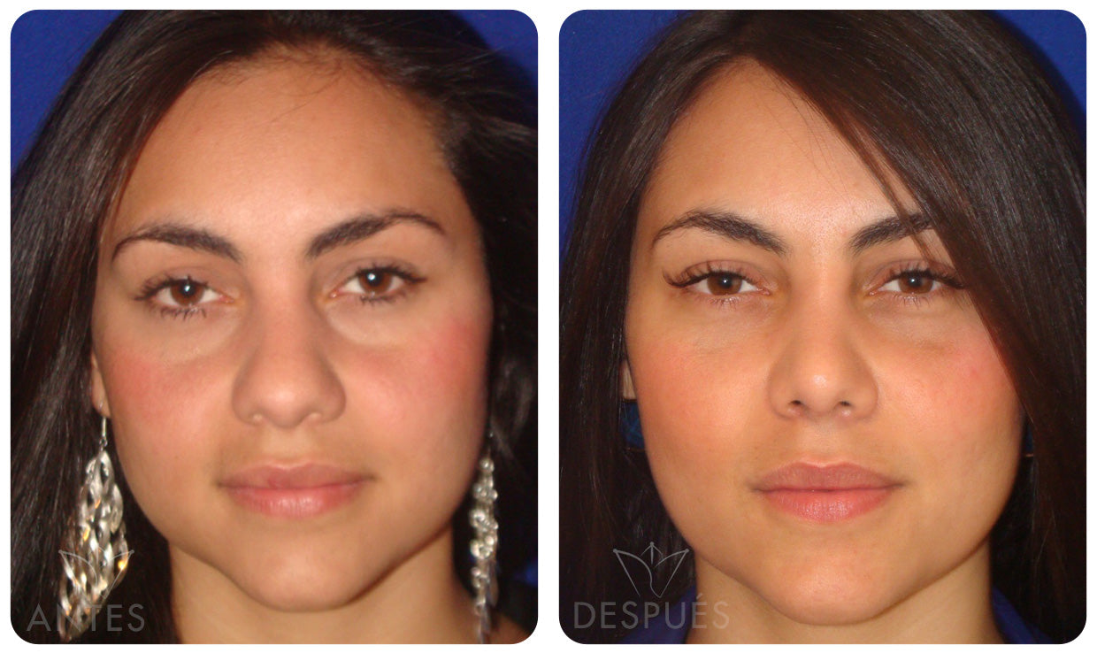 Quiero cotizar los Nano Injertos + Laser Erbium YAG