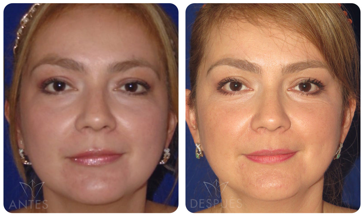 Quiero cotizar los Nano Injertos + Laser Erbium YAG