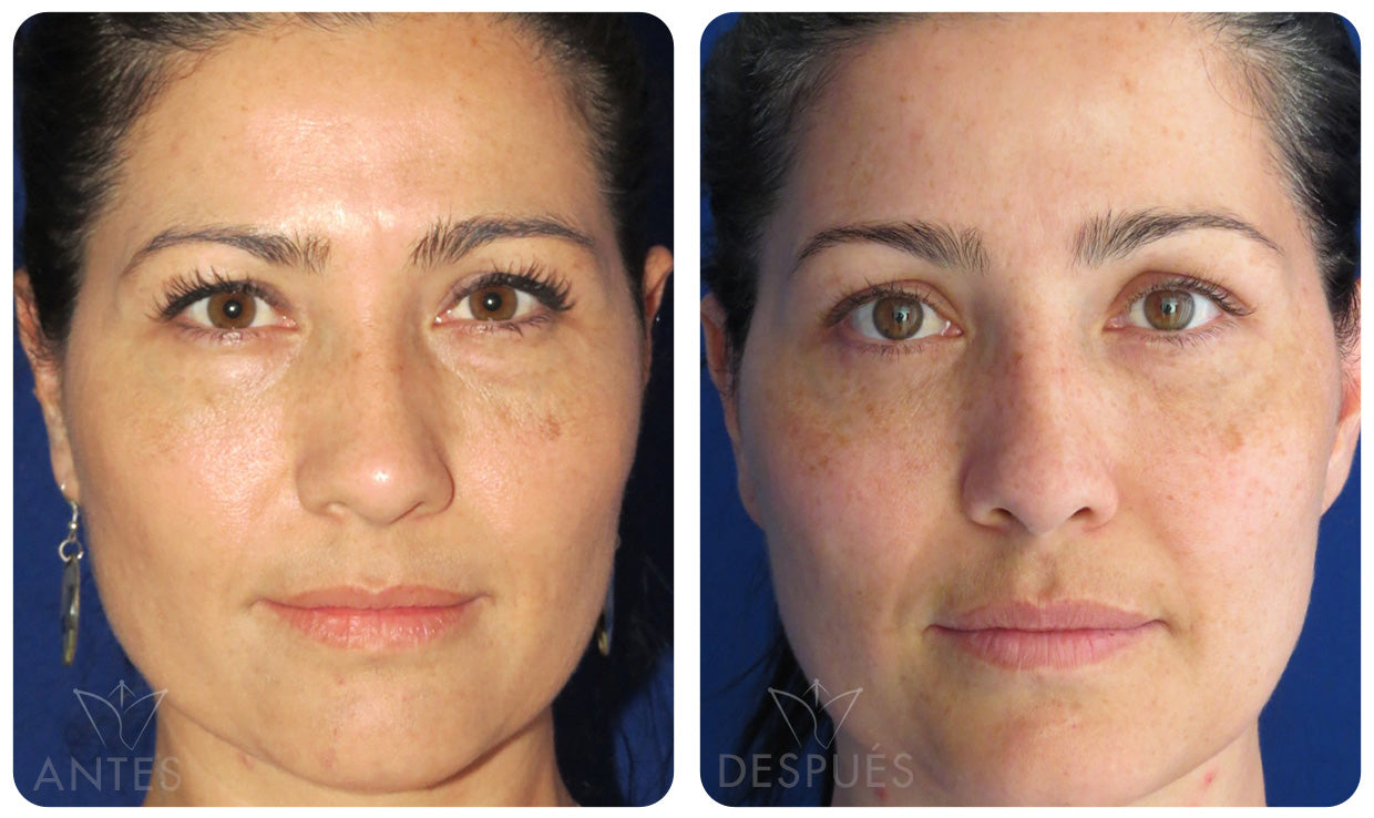 Quiero cotizar los Nano Injertos + Laser Erbium YAG