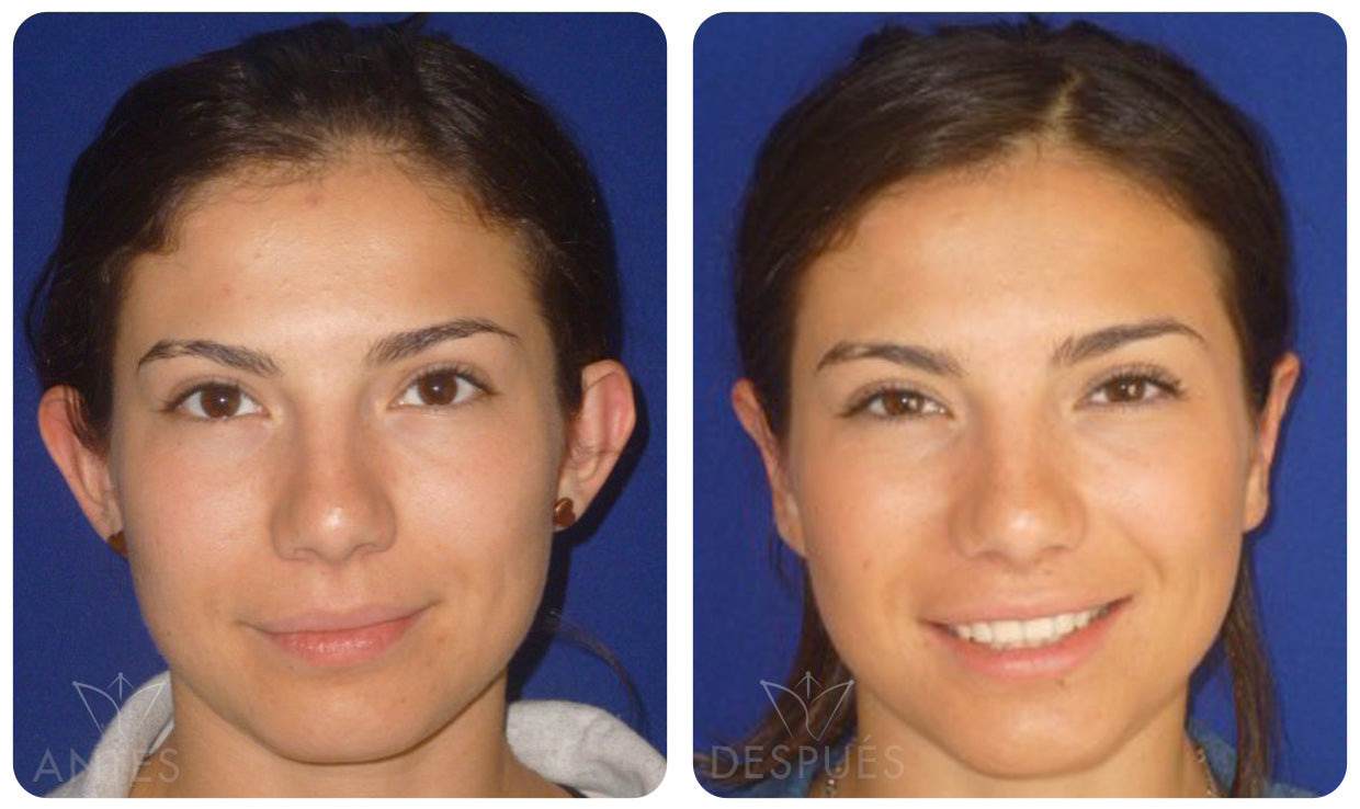 Quiero cotizar una Otoplastía