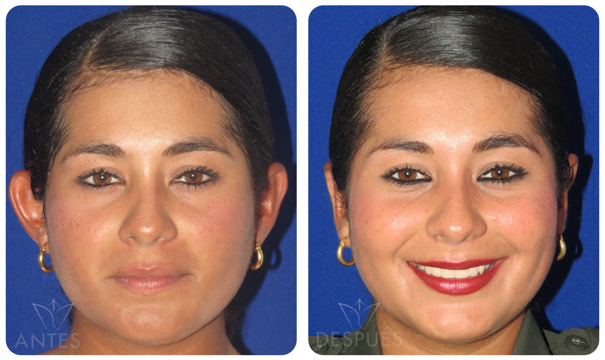 Quiero cotizar una Otoplastía