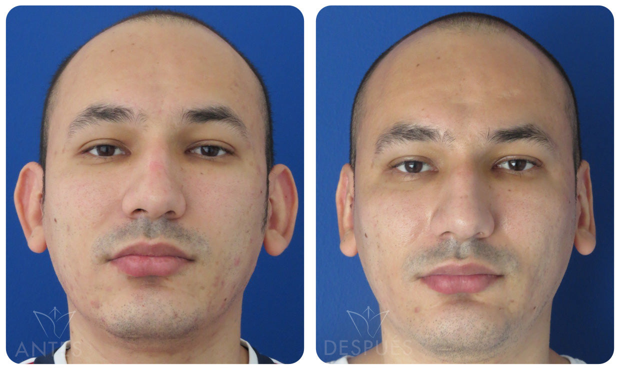 Quiero cotizar una Otoplastía