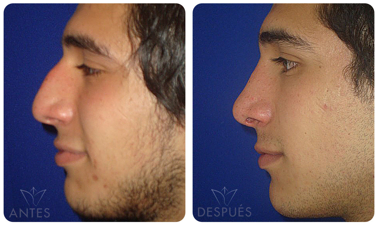 Quiero cotizar una Rinoplastía